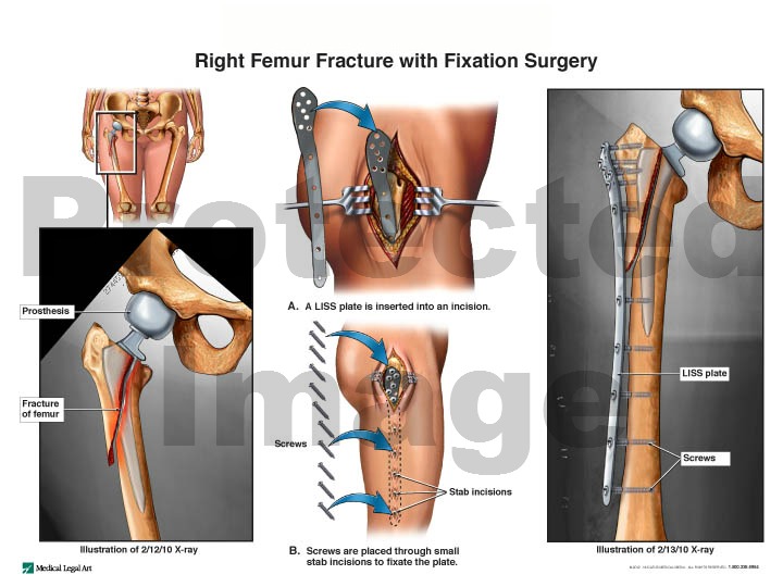 Right Femur Fracture with Fixation Surgery