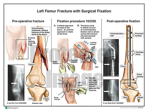 Left Femur Fracture with Surgical Fixation