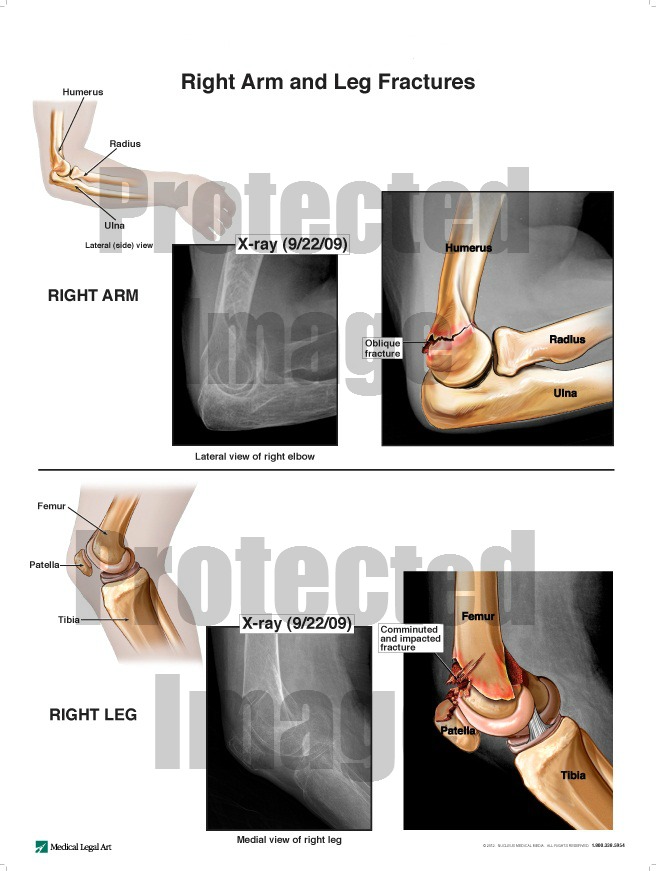 Right Arm and Leg Fractures