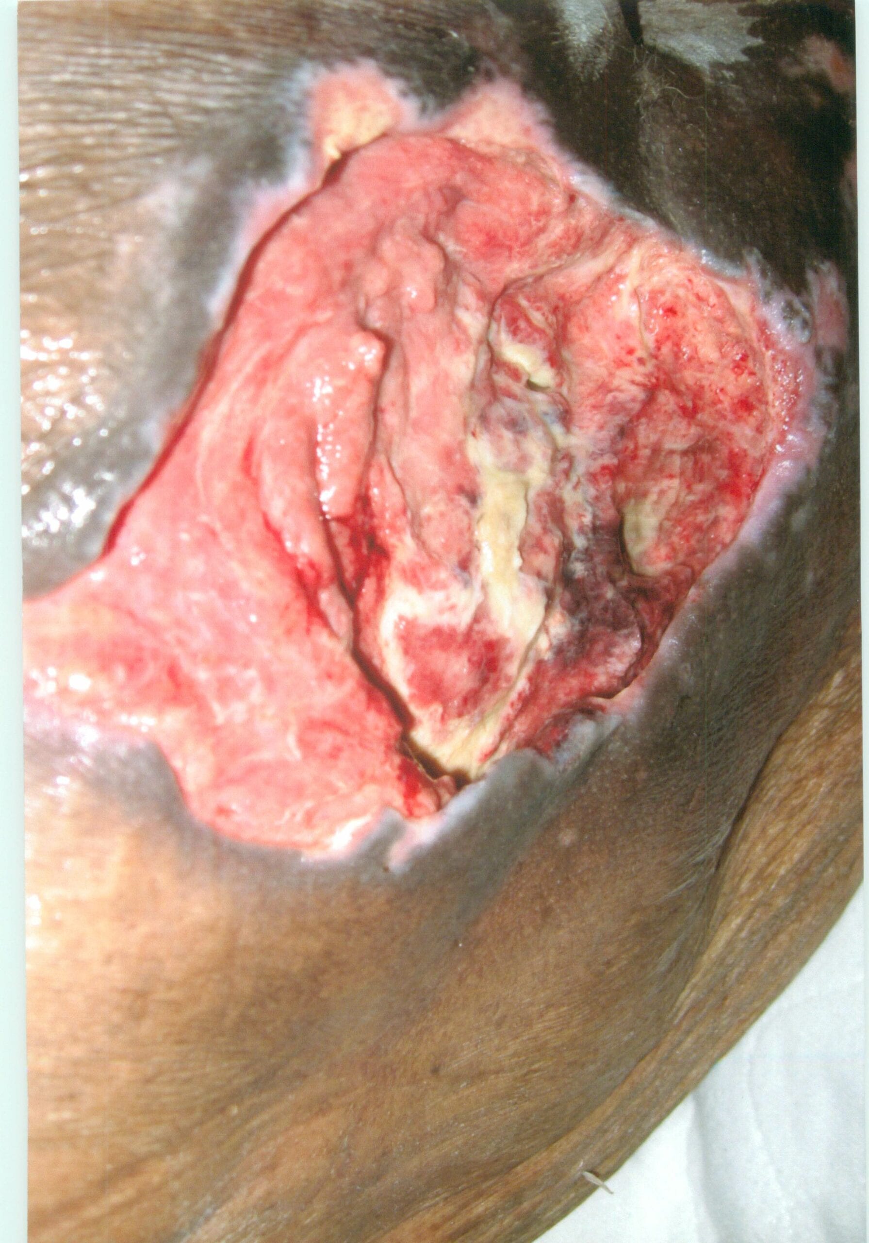 Stage IV Sacral Pressure Ulcer