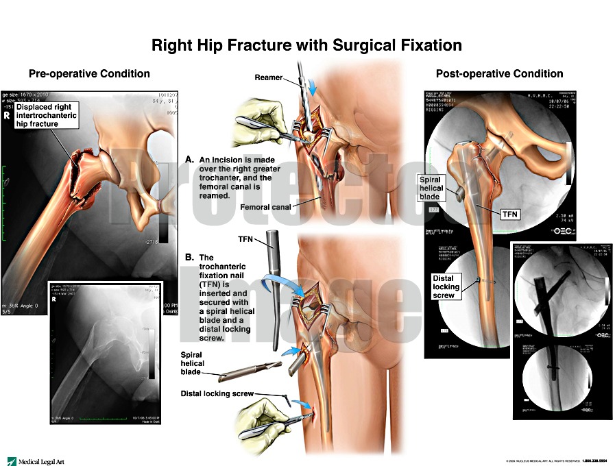 Right Hip Fracture with Surgical Fixation