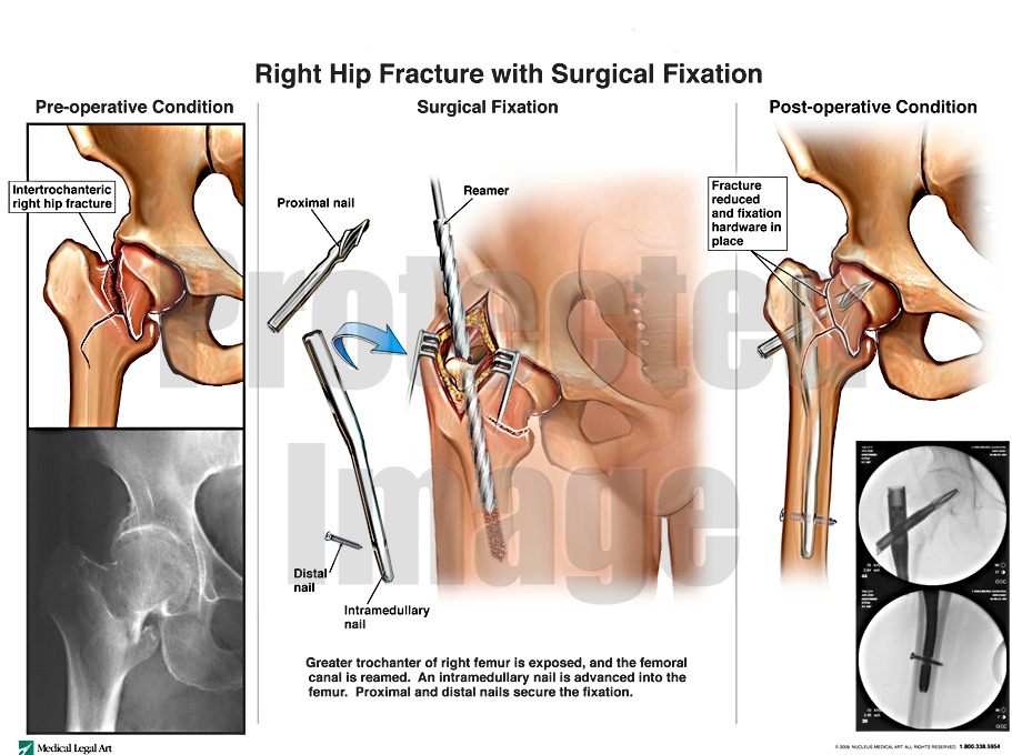 Right Hip Fracture with Surgical Fixation
