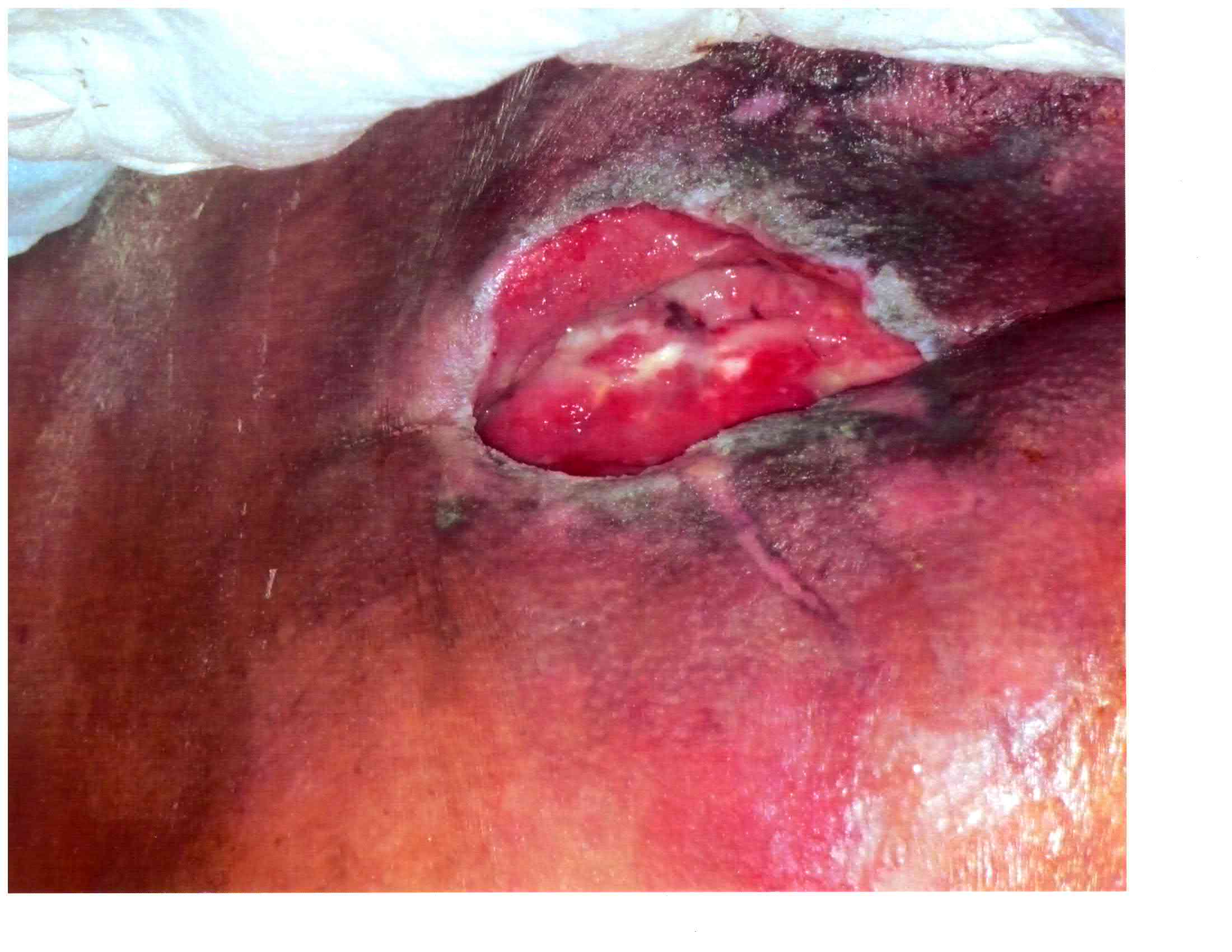pressure ulcer